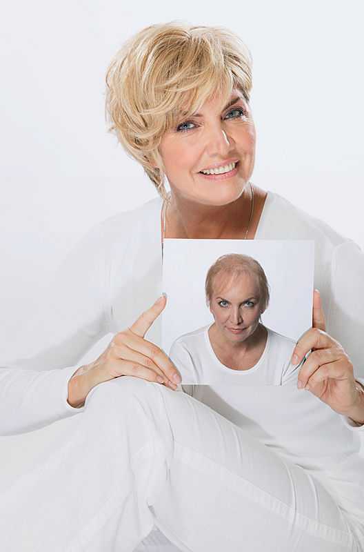 Woman holding a photo showing her past hair loss, now featuring a full head of hair.